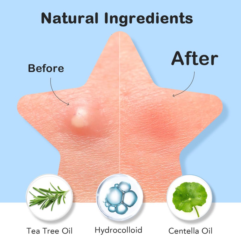 LitBear Cute Case with Pimple Patches for Face, Little Compact with Pink & Yellow Star Hydrocolloid Acne Patch, Blemish Patches, Zit Patches (120 Count) - Image 4