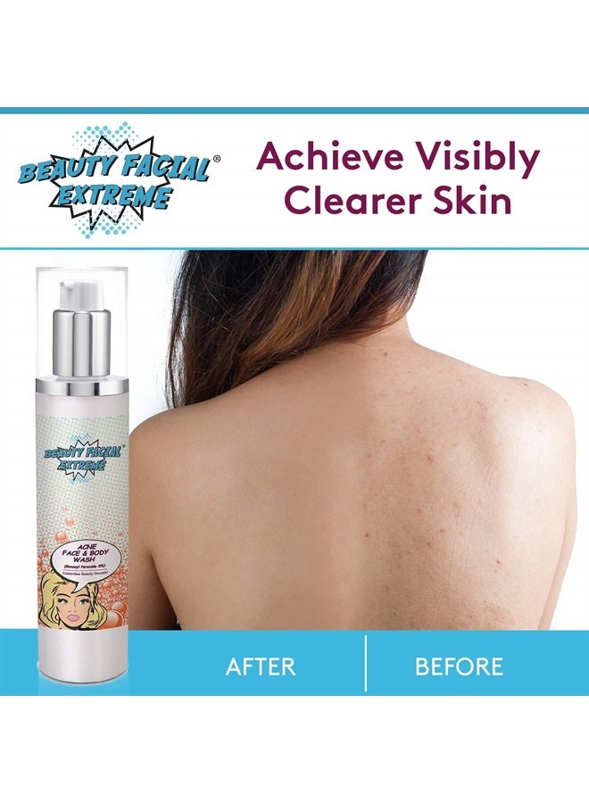 Benzoyl Peroxide 5% Acne Cleanser- Clinically Proven Wash to Fight Acne on Contact. Eliminates Cystic Breakouts, Oily Skin, Clogged Pores, Blackhead & Whitehead Pimples for Face & Body.