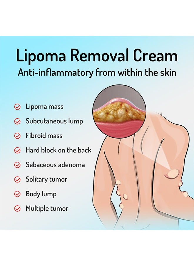 SOUTH MOON - Lipoma Cream 20g, Natural Ingredients, Easy to Absorb, Reduce The Size of Fat Tumors, Relieve Pain and Neurological Discomfort, Lipoma Elimination Cream - Image 1