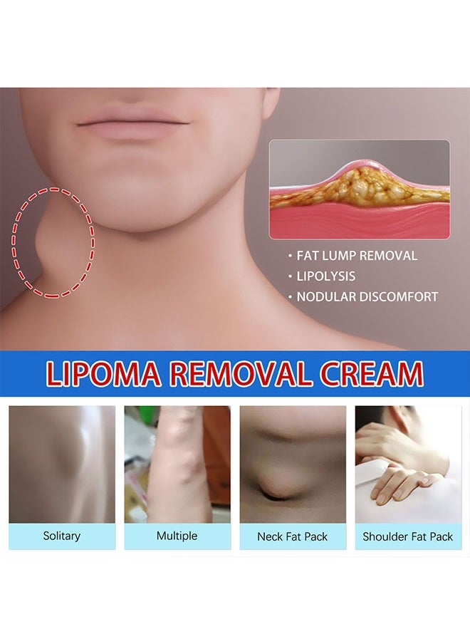 SOUTH MOON - Lipoma Cream 20g, Natural Ingredients, Easy to Absorb, Reduce The Size of Fat Tumors, Relieve Pain and Neurological Discomfort, Lipoma Elimination Cream - Image 1
