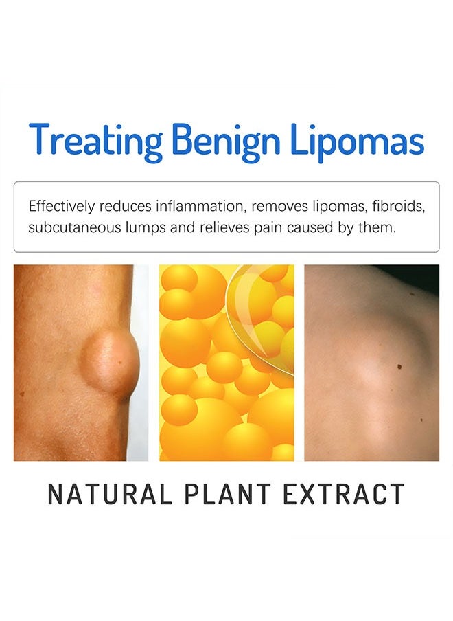 SOUTH MOON - Lipoma Cream 20g, Natural Ingredients, Easy to Absorb, Reduce The Size of Fat Tumors, Relieve Pain and Neurological Discomfort, Lipoma Elimination Cream - Image 1