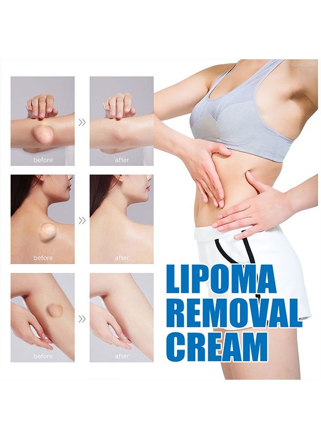 SOUTH MOON - Lipoma Cream 20g, Natural Ingredients, Easy to Absorb, Reduce The Size of Fat Tumors, Relieve Pain and Neurological Discomfort, Lipoma Elimination Cream - Image 1