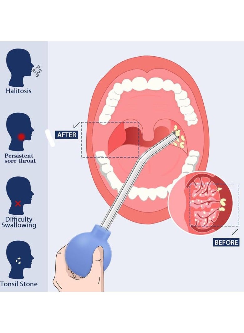 عام مجموعة مكونة من قطعة واحدة لإزالة حصوات اللوزتين، منظف فموي يدوي، جهاز شفط حصوات اللوزتين مع كرة شفط يدوية - Image 3