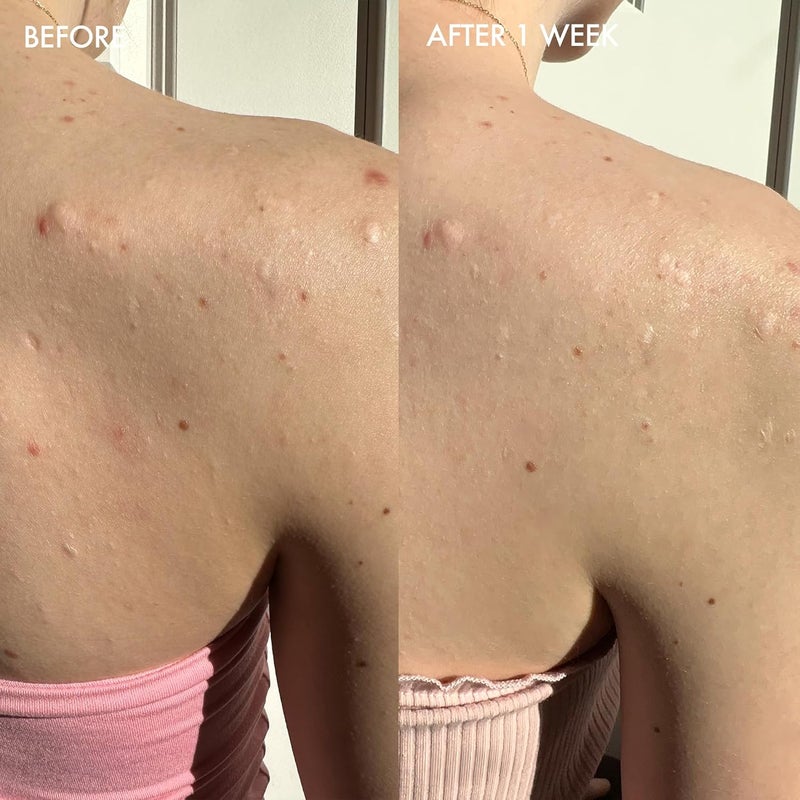 Dermisa Sulfur Bar with Aloe Vera for Oily Acne-Prone Skin - 3 oz - Image 5