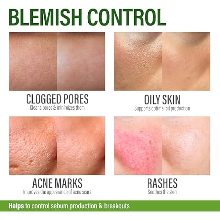 GRAMRIGHT Acne Face Cream - Acne Spot Treatment for Face & Acne Dots - Tea Tree Oil & Salicylic Acid - Natural Cystic Acne Treatment - Made in USA - For All Skin Types - Acne Scar Cream & Pimple Remover 4 fl.oz - Image 4