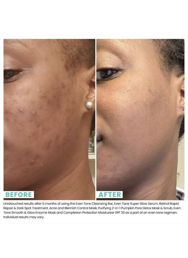 Acne and Blemish Control Mask | Dual-action Mask Fights Acne & Prevents Future Breakouts. Formulated with Sulfur, Salicylic Acid and Niacinamide | 2.5 Oz
