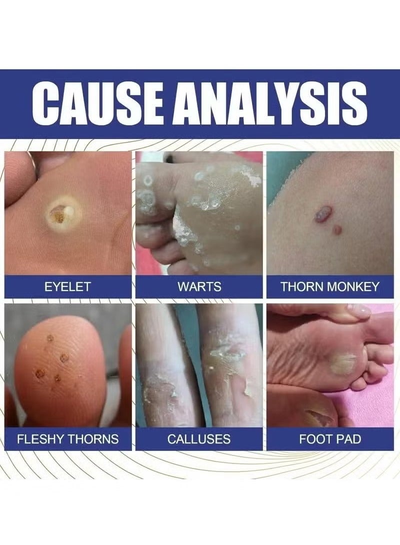 Lanthome Wart Remover, Fast Acting and Painless Skin Tag Remover Liquid, Tags and Mole Remover, Tag-Remover for Hands and Body, Wart Cream for Genital Warts, Plantar Wart, Common Wart, Corn, Flat Wart - Image 5