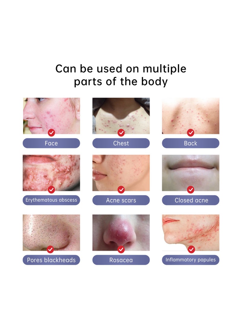 AuQuest - Herbal Acne Treatment Cream Pimple Spot Removal for Teens Oil Control Acne Scar Gel Shrink Pores Skin Care Beauty Health - Image 1