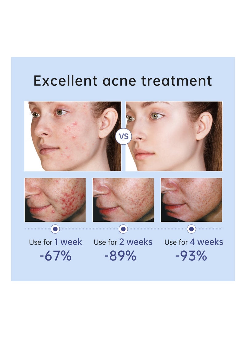 AuQuest - Herbal Acne Treatment Cream Pimple Spot Removal for Teens Oil Control Acne Scar Gel Shrink Pores Skin Care Beauty Health - Image 1