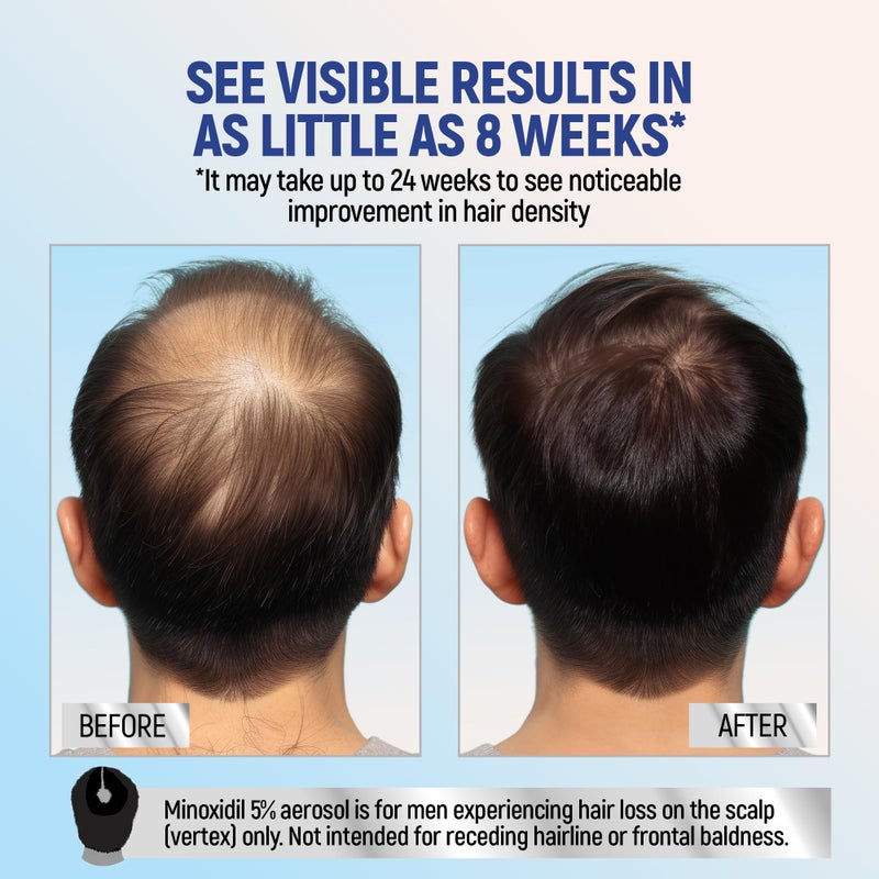 Taro Minoxidil Topical Aerosol Foam, 5%, Hair Regrowth 4 Months Treatment for Men, 2.11 oz (4 Pack) - Image 3