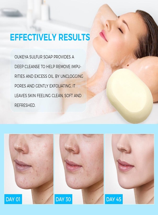 OUKEYA Sulfur Soap for Face with 10% Sulfur, 2% Salicylic Acid, Sulphur Soap Bars with Goat Milk & Tea Tree Oil, Gentle Cleanser Hydrating Aloe & Hyaluronic Acid (2Packs) - Image 4