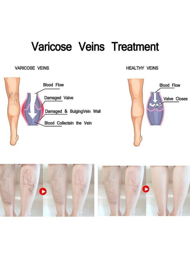 ANYI Varicose Vein Cream  - Image 4