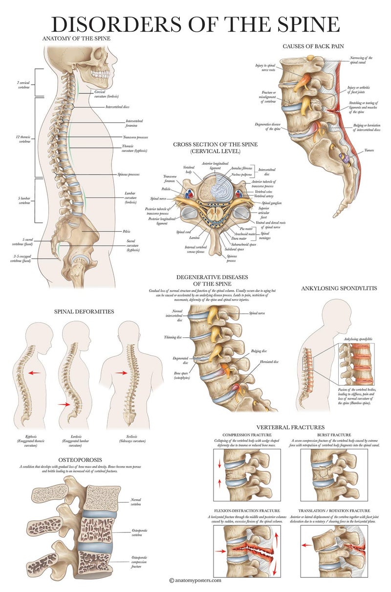 Palace Learning 2 Pack: Spinal and Cranial Nerves + Disorders of the Spine Poster Set - Set of 2 Anatomical Charts - Laminated - 18" x 24" - Image 4