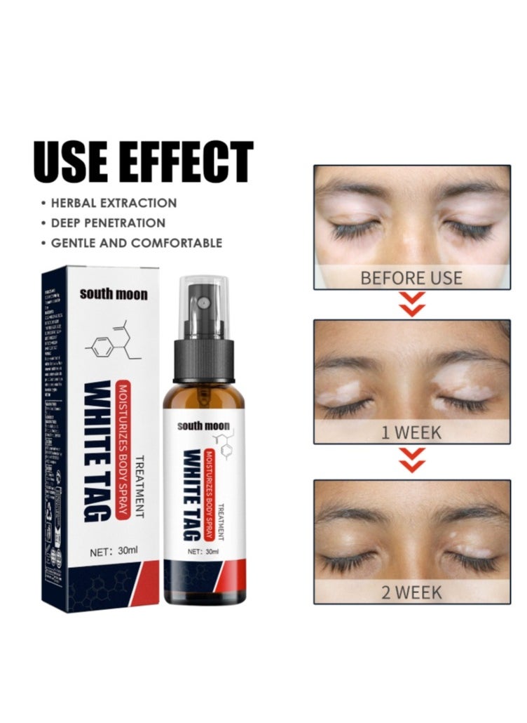 SOUTH MOON White Tag Spot Remover Spray Vitiligo Ointment,  For Skin Vitiligo, Vitiligo Care Cream For Reduce White Spots Repair Spray 30ml  - Image 4