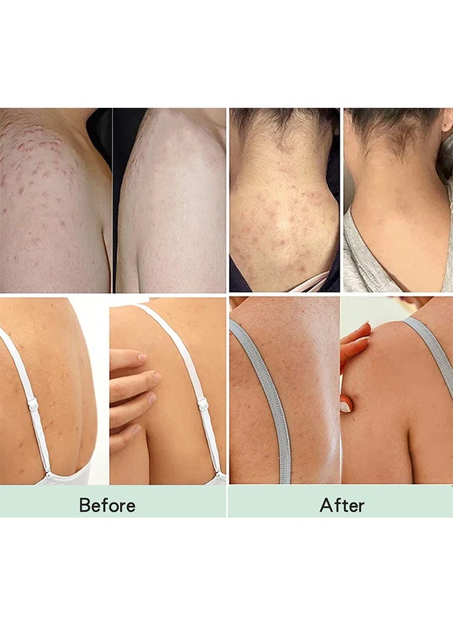 EELHOE Back Acne Soothing Spray, Back Acne Spray, 2% Salicylic Acid Spray, Body Acne Treatment with Herbal Formula, Body Acne Spray, Tea Tree Oil Spray, Acne Treatment For Teens, Back Acne 120ml - Image 4