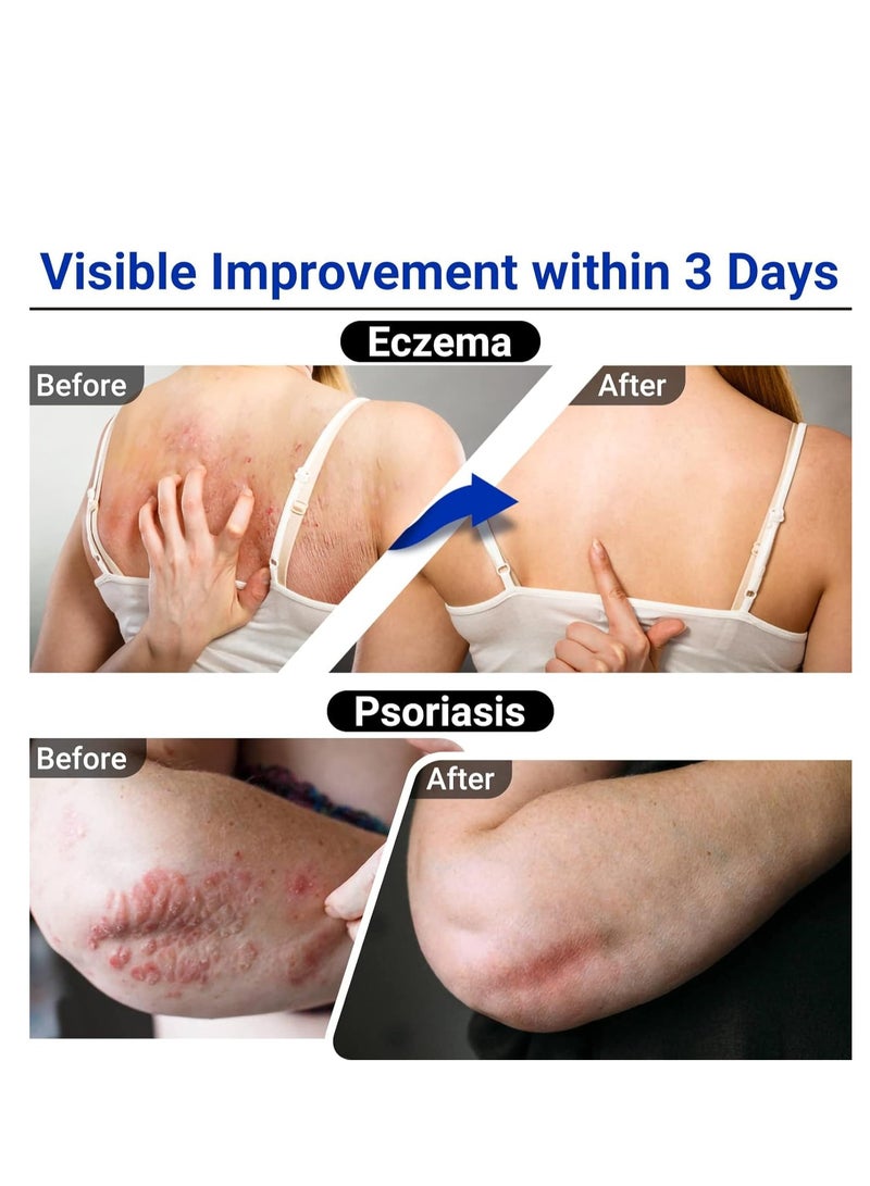 لمنوب Eczema Cream, Maximum Strength Therapeutic Ointment for Rashes, Psoriasis, Dermatitis, Urticaria, Tinea Foot, Jock Itch, Fungal Infection, Anti-Itch, Relieves Skin Sensitivity, Irritated 100g - Image 4
