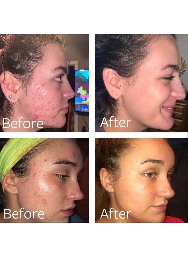 Dr Song Benzoyl Peroxide Wash 10% Acne Treatment: Acne Face Wash & Body Wash (8 Fl Oz (Pack of 1)) - Image 2