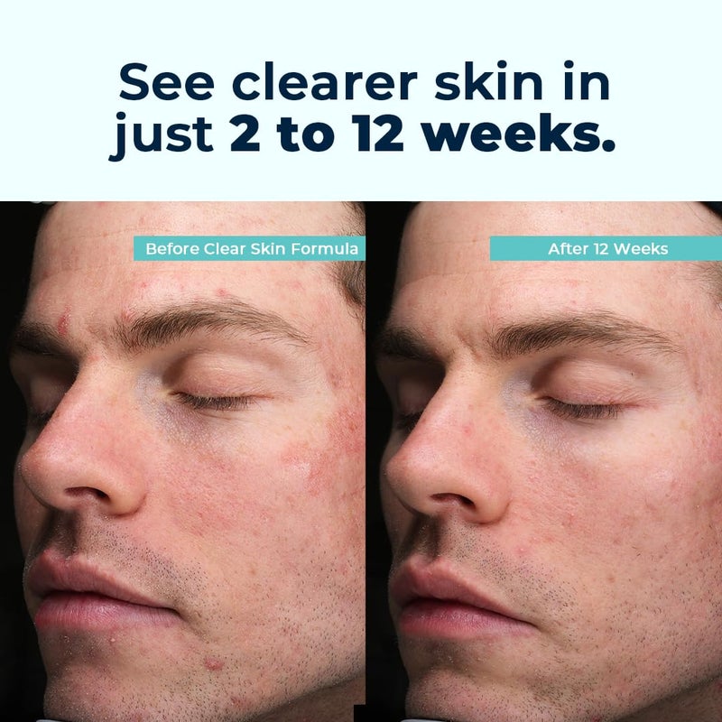 VitaMedica Clear Skin Vitamin Formula | Noncystic Acne Supplement for Skin Clearing | Clear Complexion for Women and Men | Vitamins A, C, E, Selenium, Chromium, and Zinc for Skin Health | 60 Count - Image 4