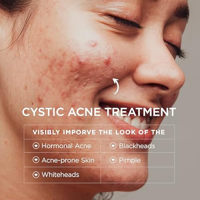 BELLAMILUXX Cystic Acne Treatment for Face: Hormonal Acne Treatment Cream for Teens & Adults - Salicylic Acid & Tea Tree Oil Pimple Spot Remover - Anti-Acne Moisturizer Reduces Redness, Blemishes - Image 3