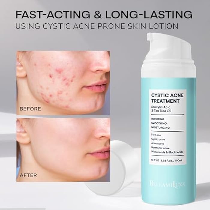 BELLAMILUXX Cystic Acne Treatment for Face: Hormonal Acne Treatment Cream for Teens & Adults - Salicylic Acid & Tea Tree Oil Pimple Spot Remover - Anti-Acne Moisturizer Reduces Redness, Blemishes - Image 4