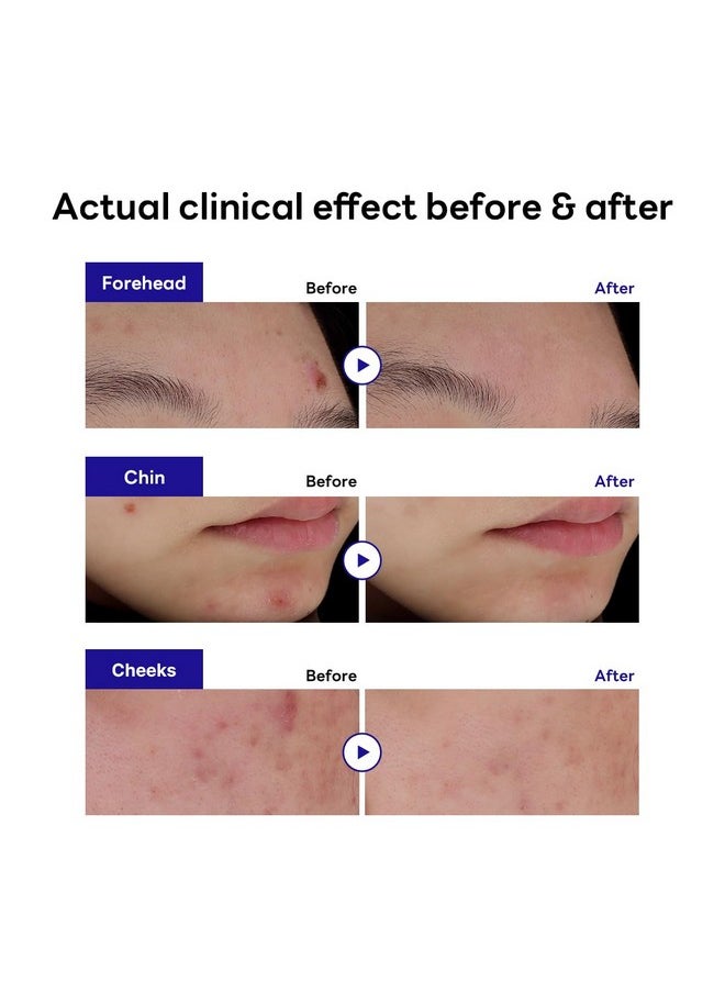 MEDIHEAL - Derma Clear Madecassoside Blemish Spot Patch (132 Counts) Acne Spot Protection Spot Fast Healing With Madecassoside & Niacinamide - Image 1