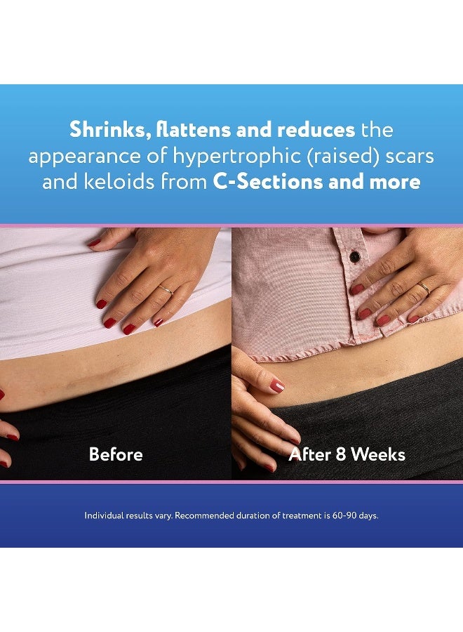 SCARAWAY C-Section Scar Treatment Silicone Adhesive Soft Fabric 4-Sheets Strips (7x1.5in) - Image 5