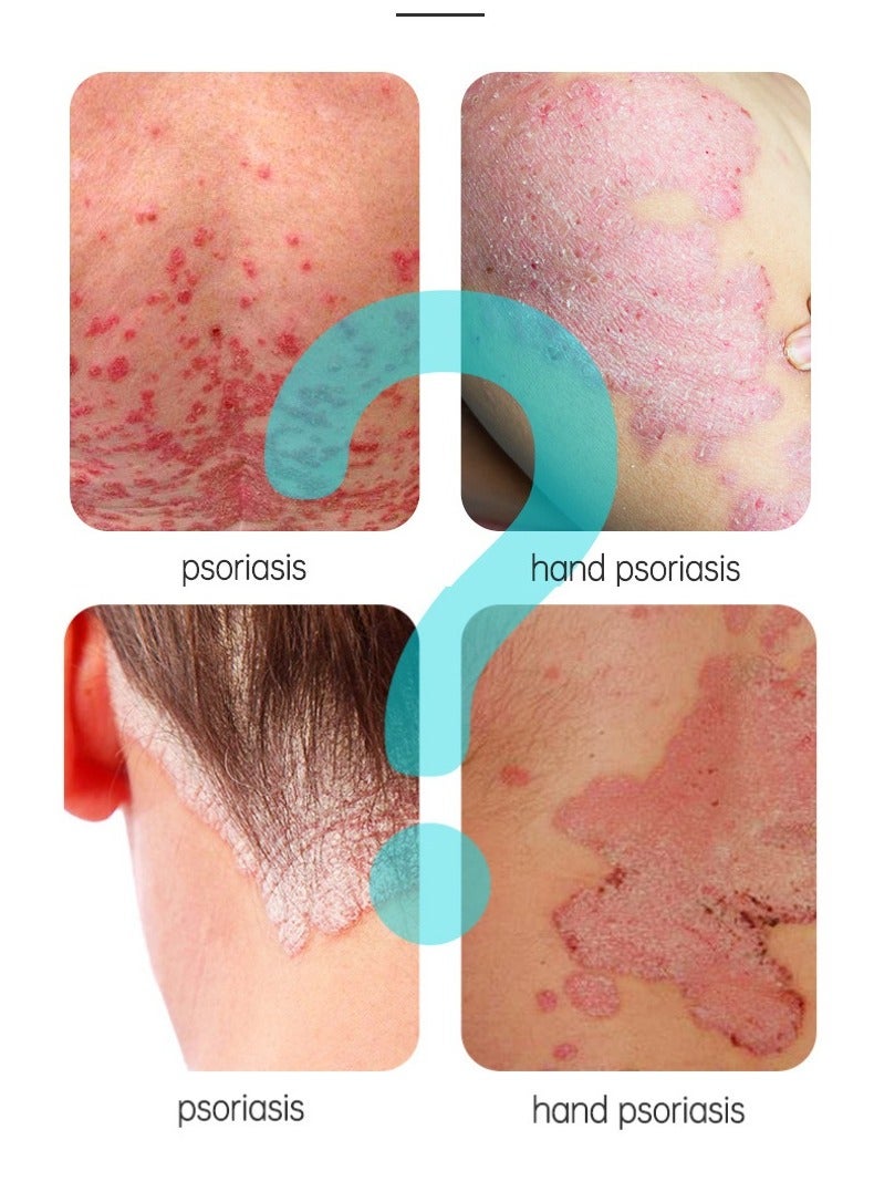 جوي برتي 2-PACKS Psoriasis Relief Cream , Anti-Bacterial Moisturizer for Scaly Skin u0026 Redness – Natural Herbal Cream for Eczema, Dermatitis, Psoriasis, and Vitiligo – Unisex (20g*2) - Image 3