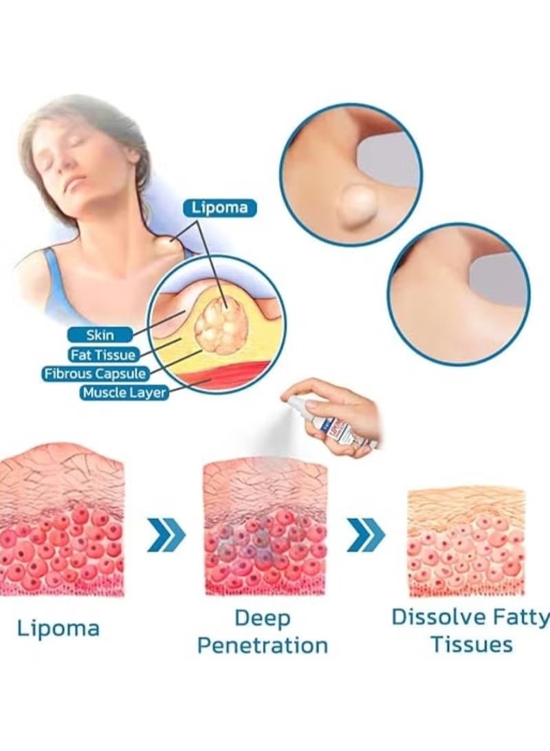 SOUTH MOON Southmoon Lumpfree Lipoma Removal Spray, , Lipomheilung Reduction Spray, Instant Lipoma Removal Spray, Skin Tightening Spray 50ml. - Image 5