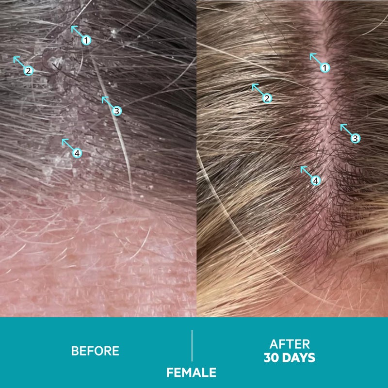 DS LABORATORIES بلسم داندري من دي إس لابز، 205 مل - لفروة الرأس الحاكة والمتقشرة، بلسم مرطب مع الألوة فيرا، يدعم صحة فروة الرأس والتحكم في الزيوت، لعلاج التهاب الجلد الدهني والصدفية - Image 4