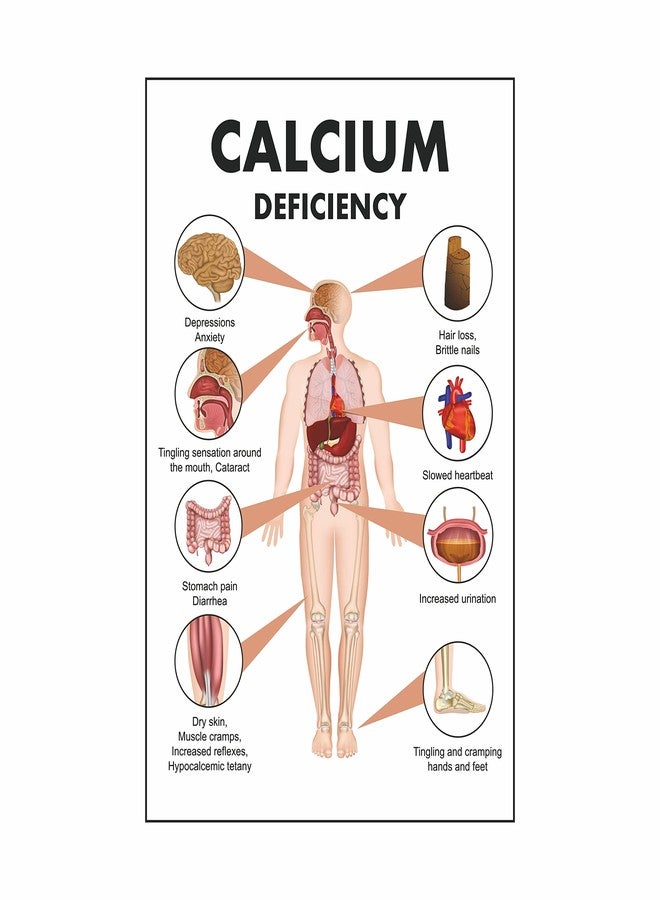 Anne Print Solutions Calcium Deficiency Poster for Hospital, Nursing Home, Clinic (Size 13X19 Inch, Printed on Non-Tearable Imported Sheet) - Image 1