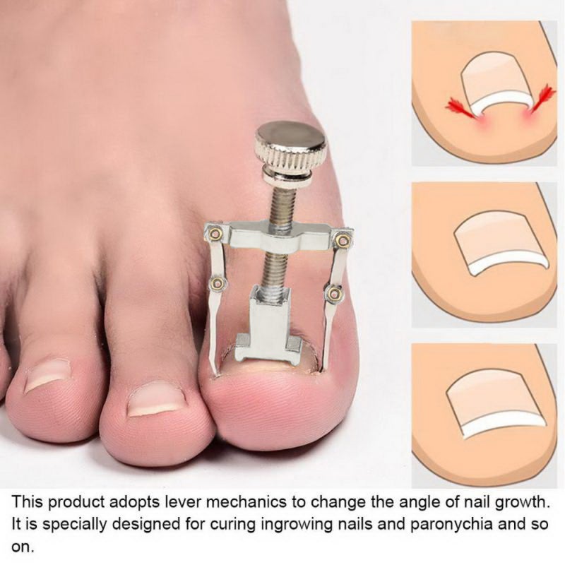 Ingrown Nail Correction Toenail Lifter Stainless Steel - Effective Treatment Toenail Clamp Breathable Design for Pain Relief - Image 5