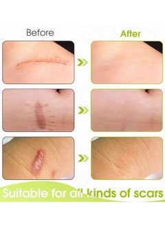 SOUTH MOON Silicone Scar Sheets, Fade Scars Efficient Cosmetic Scar Removal For Cesarean Section Burn Scars And Other Scars Left Behind Gel Painless Tape Roll (4cm X 1.5m)  - Image 5