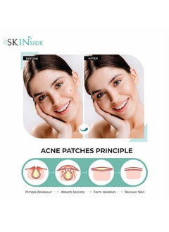 Skinside Acne Pimple Patches For Face Pimples Hydrocolloid Facial Spot Patches With 0.5% Salicylic Acid For Pimple Healing Invisible Waterproof Absorbs Excess Oil & Pimple Overnight (36 Patches)  - Image 5