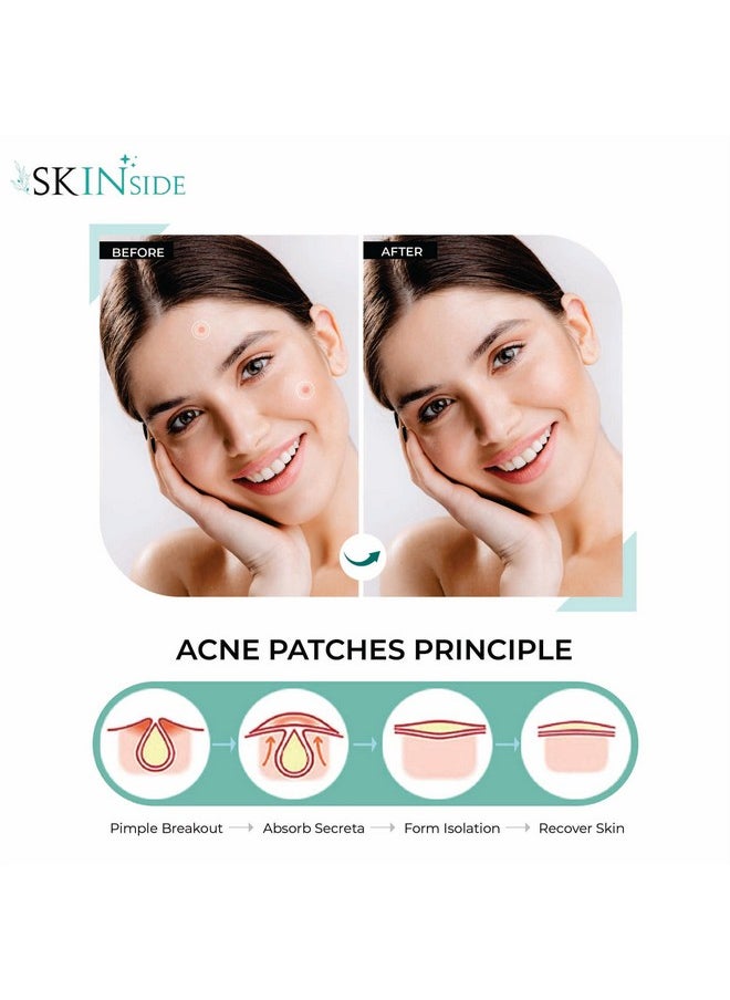 Skinside - Acne Pimple Patches For Face Pimples Hydrocolloid Facial Spot Patches With 0.5% Salicylic Acid For Pimple Healing Invisible Waterproof Absorbs Excess Oil & Pimple Overnight (36 Patches) - Image 1