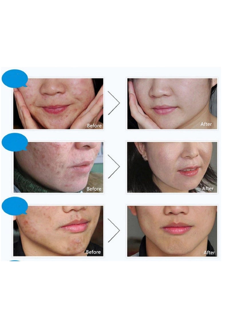 Acne Removing, Rejuvenating Cream, Acne Shrinking Pore Controlling, Moisturizing Papaya Cream 30g