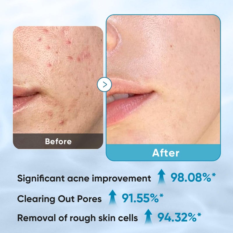 Elvira Glycolic Acid Exfoliating Facial Pads With 10% Glycolic Acid, 2% Salicylic Acid & Niacinamide - 60 Toner Pads, Daily Peel Treatment for Acne Prone Sensitive Skin - Image 3