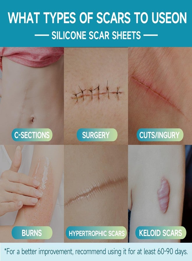Gaayou Silicone Scar Sheets, Silicone Scar Tape (1.6"x120 " Roll-3M) Reusable Professional Scar Silicone Strips Soft Silicone Scar Patches for Scar Removal Treatment, Surgical Scars, Keloid, C-Section, Burn - Image 3