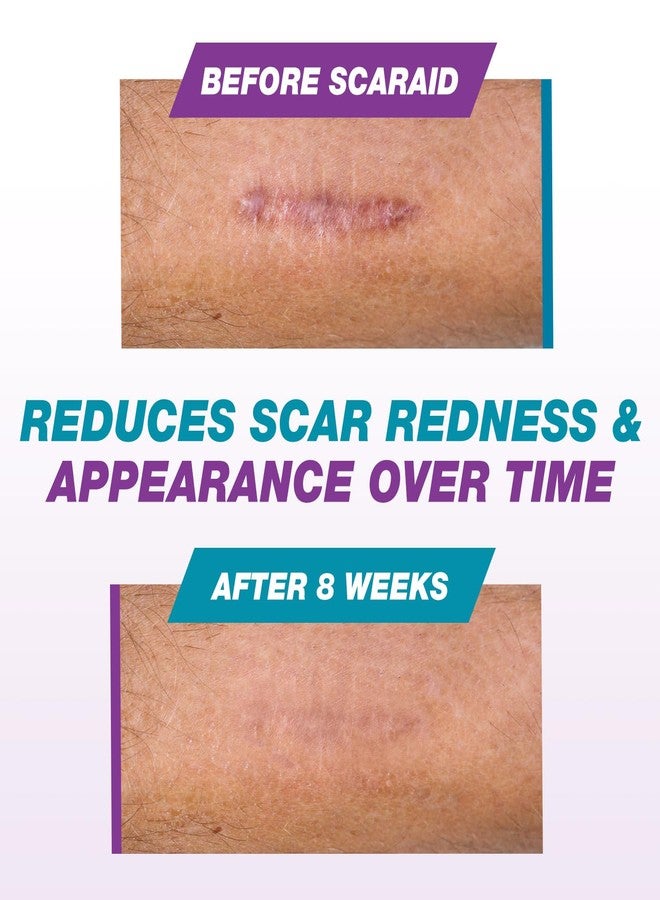 ScarAid جل سيليكون لعلاج الندبات بعد العمليات الجراحية، والولادة القيصرية، والجُدرة - جل سيليكون لعلاج الندبات الجراحية، وإزالة الندبات العميقة، وكريم مُساعد على التئام الندبات القديمة والجديدة - 4.25 غرام - Image 5