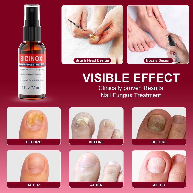 sidinox Toenail Fungus Treatment, Treatment Extra Strength with 25% Undecylenic Acid, Fungus Nail Treatment for Damaged Nails, Discolored, Thick Toenails, Help Nail Grow - (1 Fl Oz/30 ml x 5 Pack) - Image 4