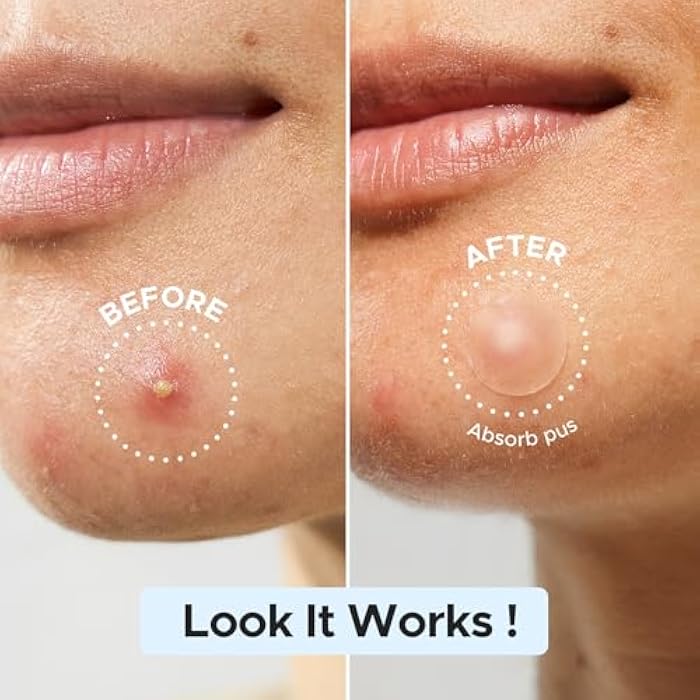 LitBear Pimple Patch Bulk, 480 Patches 3 Size Acne Patches for Face, Hydrocolloid Spot Stickers for Covering Zits, Blemishes, and Breakouts, Suitable for All Skin Types - Image 4