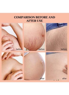 CARVENCHY Stretch Marks Essential Oil, 100% Pure Natural Plant Extracts 30ml, Improves Scars and Stretch Marks, Even Skin Tone,Natural Formulation  - Image 3