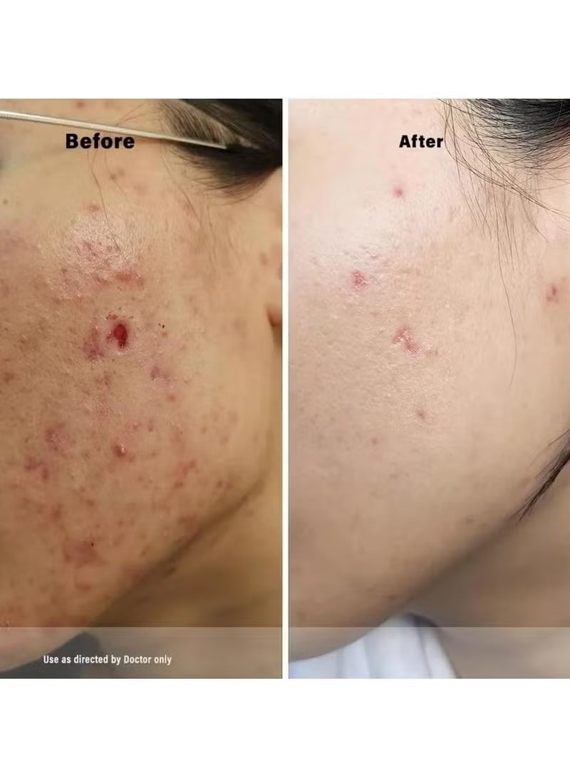 Acretin 0.05% For Acne Treatment Cream 30g - Image 3