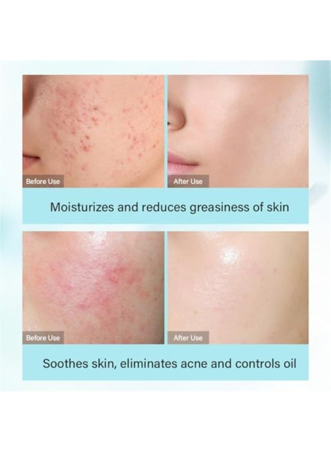 مويكا مجموعة العناية بالبشرة لعلاج حب الشباب من شجرة الشاي، مجموعة العناية بالبشرة للمراهقات 4 في 1، للتحكم في الدهون والترطيب مع منظف، تونر، سيروم وكريمة - Image 3