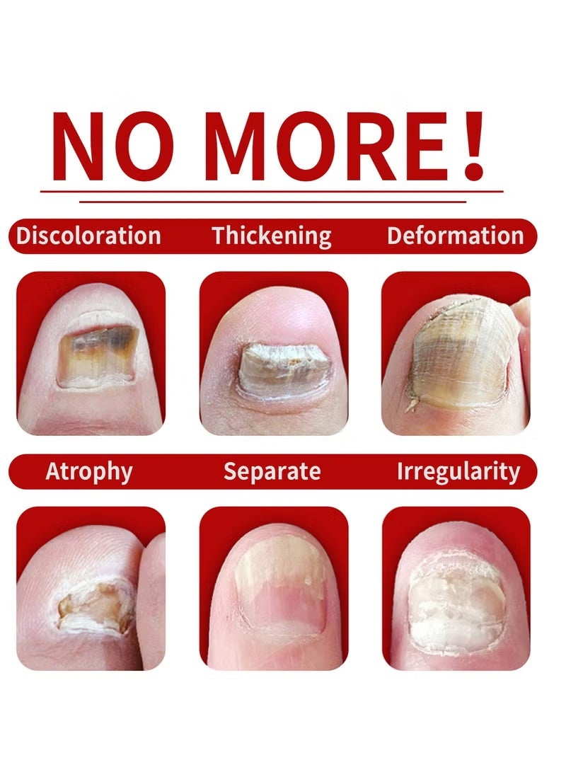 Jaysuing Nail Fungus Treatment for Nail Care Onychomycosis Repair and Moisturizing - Image 5