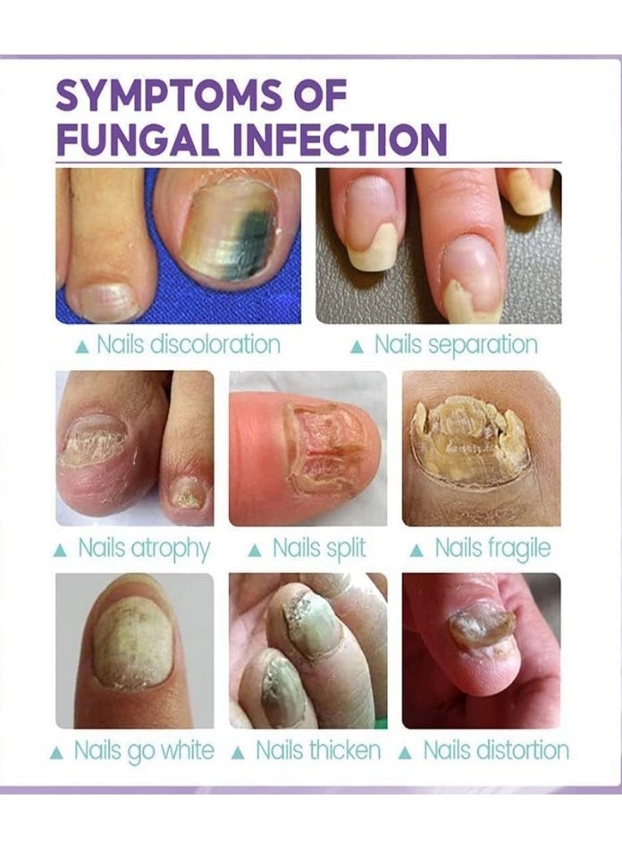 Jaysuing 1-Piece Fungus Spray, Nail Fungus Treatment For Toenail And Nail Strengthener - Image 5
