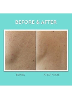 BLISS Clear Genius Body Acne Spray - 3.5 Fl Oz - Maximum Strength 2% Salicylic Acid & Niacinamide - Targets Body Acne & Prevents Future Breakouts - Post Workout - Clean - Vegan & Cruelty-Free  - Image 3