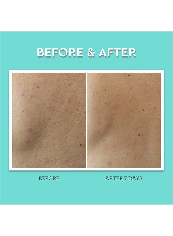 BLISS Clear Genius Body Acne Spray - 3.5 Fl Oz - Maximum Strength 2% Salicylic Acid & Niacinamide - Targets Body Acne & Prevents Future Breakouts - Post Workout - Clean - Vegan & Cruelty-Free  - Image 3