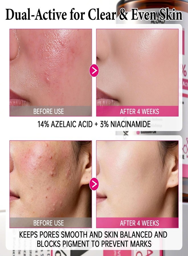 CHANGARLOAD 14% Azelaic Acid Facial Serum with Niacinamide & Hyaluronic Acid – Helps Calm Redness,Improve Blemishes & Dark Spots,Gentle Care for Sensitive Skin,40ml / 1.4 fl oz - Image 5