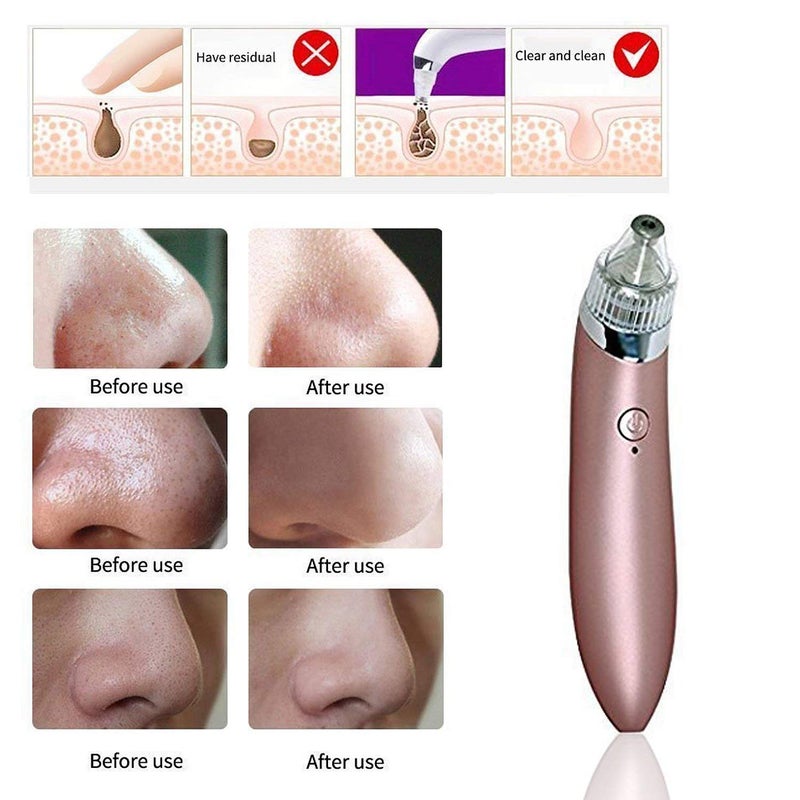 Spaceshoop Facial Pore Cleaner Blackhead Vacuum Suction Remover,Electric Facial Pore Cleanser Blackhead Remover Vacuum Suction Machine - Image 3