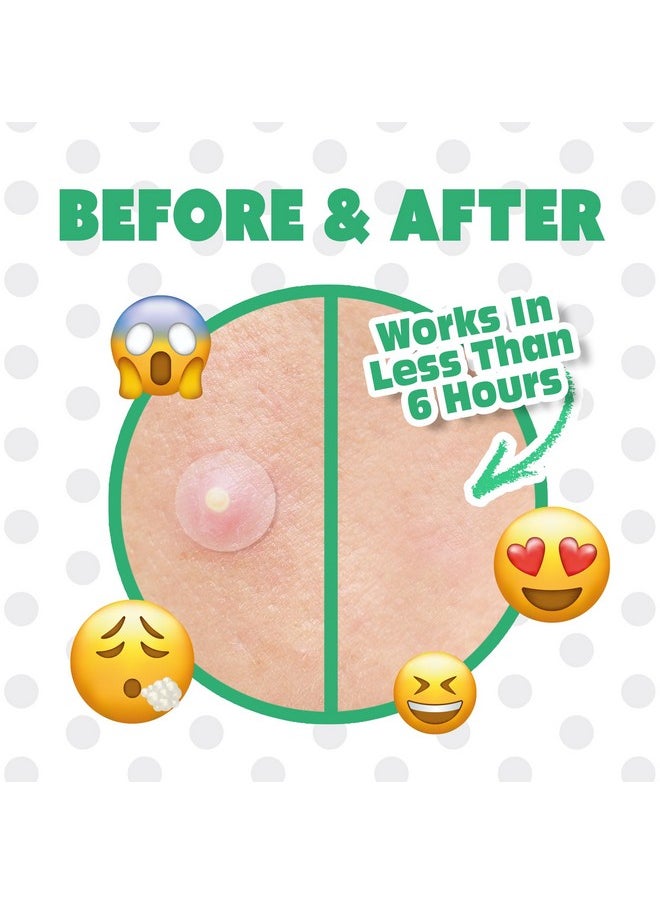 EBIN NEW YORK Pimple Buster Pimple Patches For Face Tea Tree Hydrocolloid Acne Patches For Blemishes & Breakouts And Absorbing Zits Recover The Spot Quickly Cover Spot From Dirt Invisible Finished  - Image 3